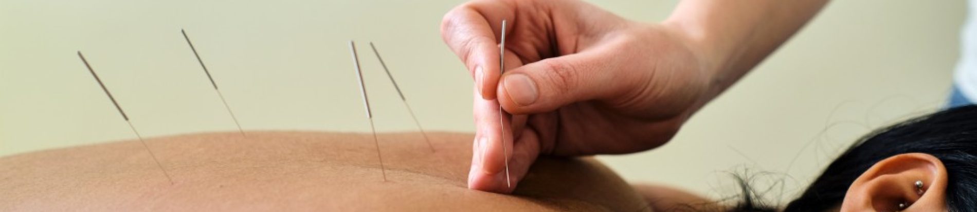 Traditional Chinese Acupuncture in Edmonton